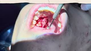 Extra tooth in the Upper Removal under 2mins actual time [upl. by Garihc]