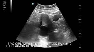 Left Lower Quadrant Abdominal Pain 810 in 13 yo Girl [upl. by Eduard]