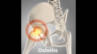 Osteitis inflammation of boneshorts [upl. by Ahsemaj75]