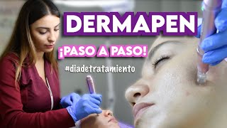 DERMAPEN  TRATAMIENTO DE MICRONEEDLING  Ximena Ramaya [upl. by Ayyn]