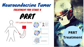 PRRT Treatment Neuroendocrine Tumors [upl. by Airahcaz]