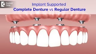 Advantages of Implant Supported Complete Denture  Dr Shahul Hameed  Doctors Circle [upl. by Armillas717]