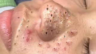 Big Cystic Acne Blackheads Extraction Blackheads amp Milia Whiteheads Removal Pimple Popping  3628 [upl. by Zoie]