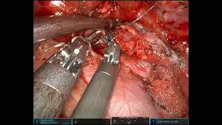 URATS left main bronchus sleeve resection and second carinal reconstruction for carcinoid tumor [upl. by Parshall29]