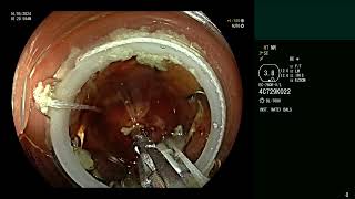 endoscopic appendectomyeFTR [upl. by Charlena]