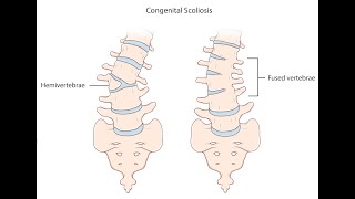 Congenital Scoliosis  Konjenital skolyoz [upl. by Notirb]