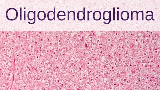 Oligodendroglioma  Pathology mini tutorial [upl. by Greg]