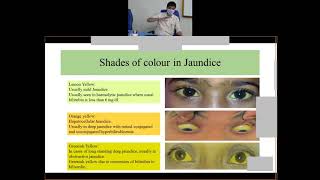 Jaundice Hyperbilirubinemia by General Hospital NEIGHRIMS Shillong [upl. by Akinet]