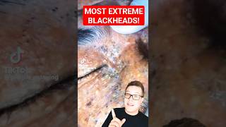 Shocking BLACKHEAD REMOVAL  Extreme Blackhead Extraction shorts [upl. by Acirret]