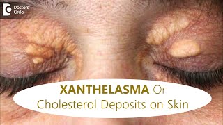 FATTY DEPOSITS of CHOLESTEROL around EYES  How to get rid of itDrRajdeep MysoreDoctors Circle [upl. by Susejedairam]