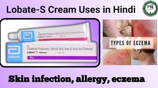 LobateS Cream Uses in Hindi  LobateS benefits  Skin infection  Psoriasis treatment  eczema [upl. by Nylad]