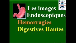 Les images endoscopiques et causes des hémorragies digestive hautes fibroscopie gastrique endoscopie [upl. by Kendell808]