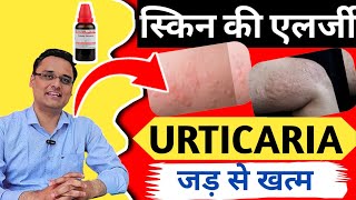 पित्ती का जड़ से इलाज Urticaria treatment skin allergy 100 khatam skin rash hives treatment [upl. by Dodwell572]