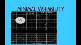 Topic 26 Intrapartum Fetal Surveillance [upl. by Asyram]