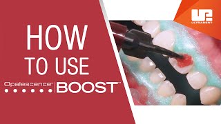 How to Use Opalescence™ Boost™ Professional Teeth Whitening  StepbyStep Procedure [upl. by Tezil577]