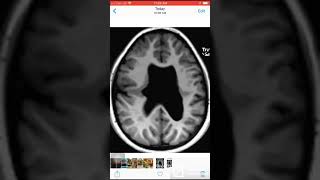 Case 036 Closed lip Schizencephaly and absent septum pellucidum [upl. by Yesnikcm650]