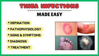 Tinea infection fungal skin infection types of tinea pathophysiology diagnosis treatment [upl. by Yttisahc]