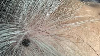 Shave biopsy lesion on scalp [upl. by Euqinehs299]