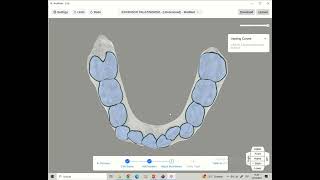 Expansor palatino removible ArchForm Titan [upl. by Tamarah]