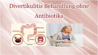 Divertikulitis Behandlung ohne Antibiotika [upl. by Cottle]