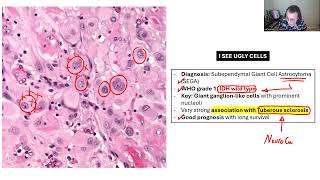 NEUROPATHOLOGY BOARD REVIEW 2 [upl. by Jereme726]