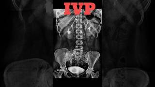 IVP  Intravenous pyelography shorts ivp specialcase radiology radiologyjunction [upl. by Vizzone715]