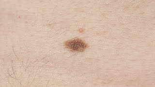 Melanoma symptoms How to spot signs and when to see a doctor [upl. by Omer]