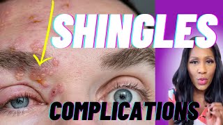 SHINGLES DANGERS Postherpetic Neuralgia Ramsay Hunt Syndrome amp Zoster Opthalmicus [upl. by Aicel]