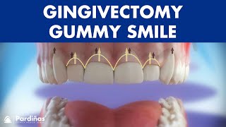 Gingivectomy  Treatment for gummy smile © [upl. by Lubin]