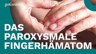 Paroxysmales Fingerhämatom – was ist das [upl. by Aggappora]