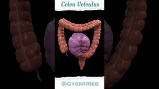 Colon Volvulus [upl. by Adnohsak]