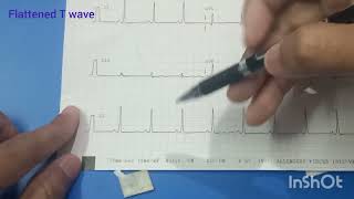 Widespread T wave abnormality I FlatFlatenned T wave l T wave amplitude l [upl. by Tiphane]