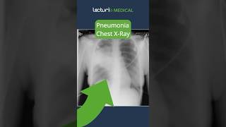 Understanding Lobar Pneumonia 🫁 MedicalEducation usmle [upl. by Hanimay]