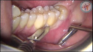 Surgical Extraction of Mesioangular Wisdom Tooth  Live demonstration [upl. by Giddings]