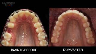 Aparat Dentar Neoclinique [upl. by Maidel690]