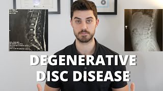 Overcome Degenerative Disc Disease [upl. by Ecnarolf]