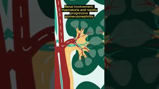 MRCP Exam tip CGPA vs EGPAGranulomatosis with polyangiitis [upl. by Clemence]