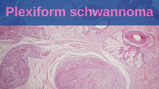 Plexiform Schwannoma  Pathology mini tutorial [upl. by Vasti323]