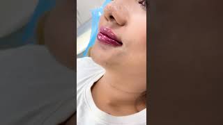 Lip Fillers Technique by Dr Muskan Tyagi  Dermalyn Aesthetics  APPOINTMENT CALL 9999189391 [upl. by Chaney]