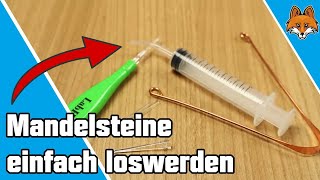 Mandelsteine selbst entfernen und ausdrücken  Mandelsteine loswerden 😷 [upl. by Dyob]