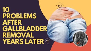 10 Problems After Gallbladder Removal Years Later  Post Gallbladder Surgery Issues [upl. by Finbar340]