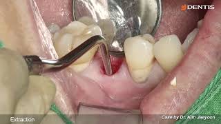 DENTIS Implant Lower premolar area immediate implant placement with SQ fixture [upl. by Eneluj]