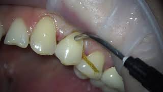 placing a filling on a tooth according to class 5  treatment of dental caries dentist teeth [upl. by Notnats]