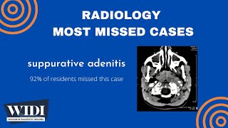 Most Missed Cases Suppurative Adenitis [upl. by Noirb]