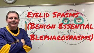 Eyelid Spasms Benign Essential Blepharospasm [upl. by Terrene]