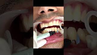 The 5 Minute Teeth Whitening Trick Thats Changing Smiles shorts [upl. by Rotce500]