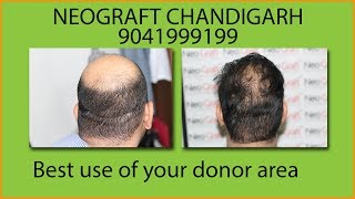 Full head hair transplant weak donor areaHair Transplant Chandigarh [upl. by Pierce]