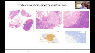 Sentinel lymph node in endometrial cancer [upl. by Car]