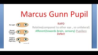 Ophthalmology Marcus Gunn Pupil RAPD Relative Afferent Pupillary Pathway Defect [upl. by Roxane482]