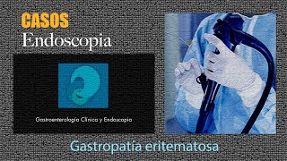 Gastropatía eritematosa [upl. by Rochette]